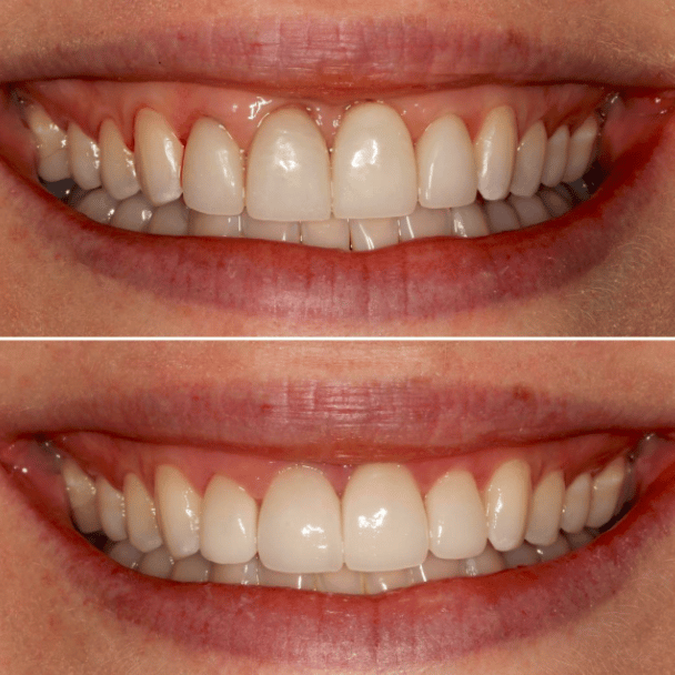 Porcelain Veneers